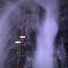Podjęli się innowacyjnego leczenia rozedmy płuc