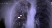 Podjęli się innowacyjnego leczenia rozedmy płuc
