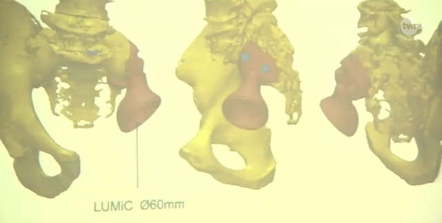 Ortopedzi wszczepili protezę 3D. Innowacyjna operacja w Poznaniu - full image