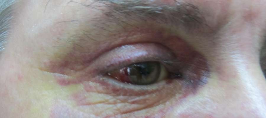 Tak wygląda oko pobitego mężczyzny prawie tydzień po zdarzeniu