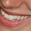 Naukowcy opracowali nową metodę regeneracji zębów. Koniec z leczeniem kanałowym?