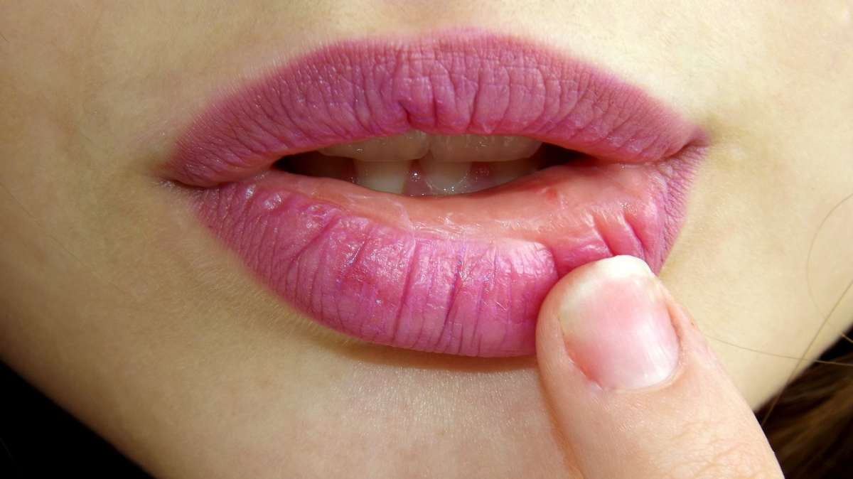 Zakaz całowania, czyli jak sobie radzić z opryszczką - full image