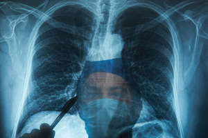 W Polsce co 20 minut ktoś umiera na raka płuca. Szybka diagnostyka i leczenie mogłyby poprawić te statystyki