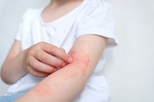 Wysypka alergiczna: wszystko, co musisz o niej wiedzieć!